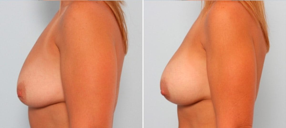Breast Augmentation Before & After Gallery - Patient 54883999 - Image 5
