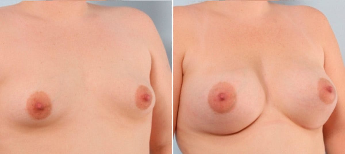 Breast Augmentation Before & After Gallery - Patient 54884001 - Image 2