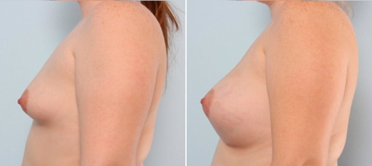 Breast Augmentation Before & After Gallery - Patient 54884001 - Image 5