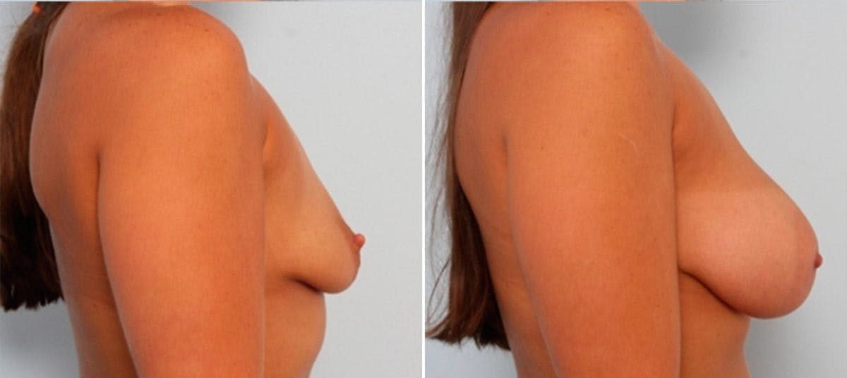 Breast Augmentation Before & After Gallery - Patient 54884006 - Image 3