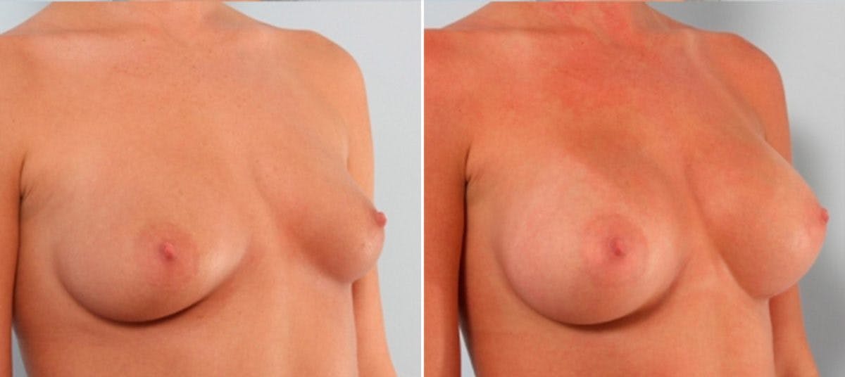 Breast Augmentation Before & After Photo - Patient 54884007 - Image 2
