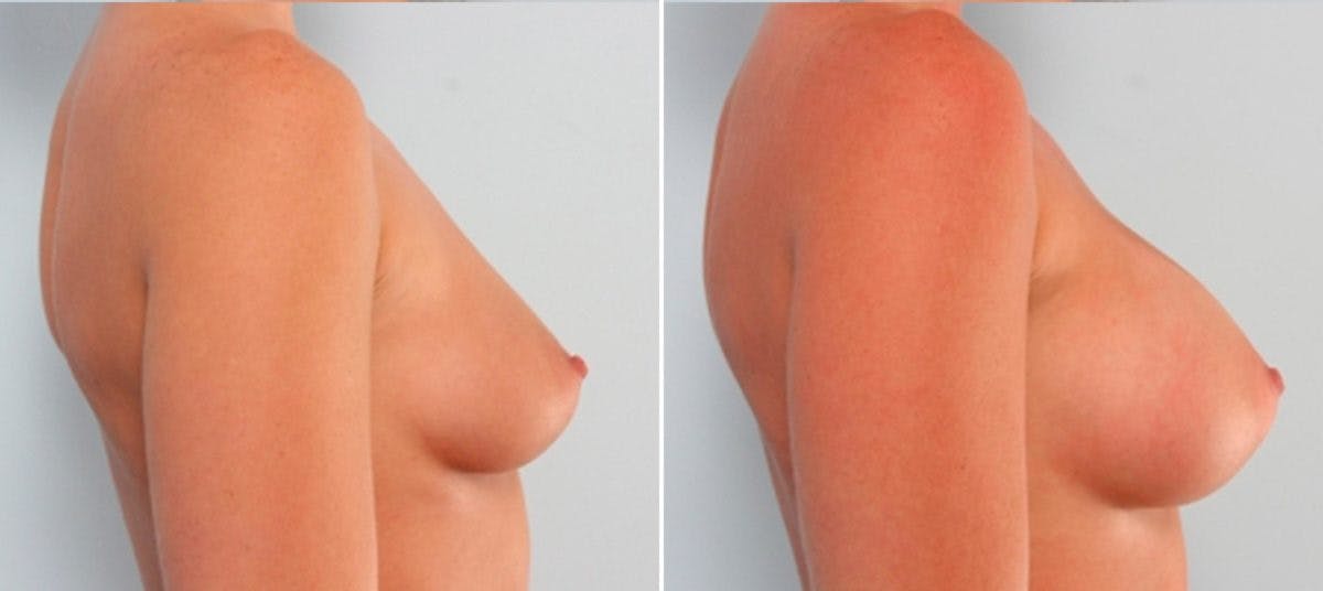 Breast Augmentation Before & After Gallery - Patient 54884007 - Image 3