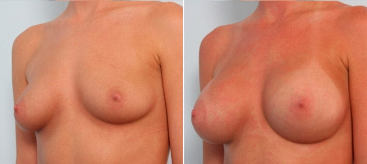 Breast Augmentation Before & After Gallery - Patient 54884007 - Image 4