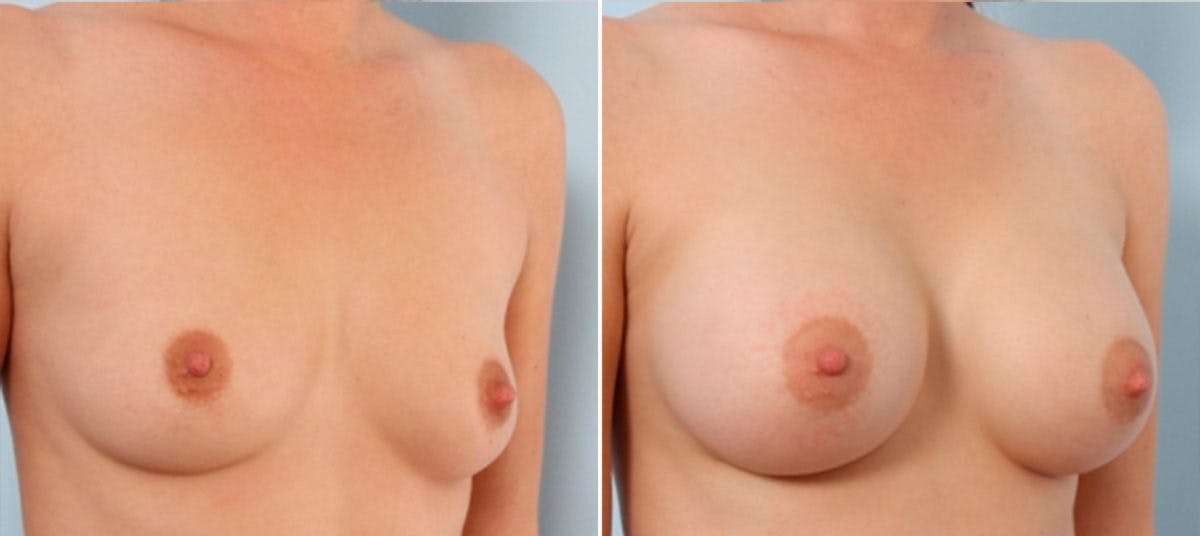 Breast Augmentation Before & After Gallery - Patient 54884008 - Image 2