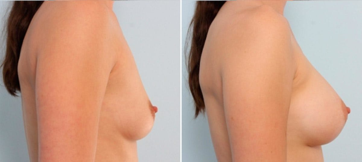 Breast Augmentation Before & After Gallery - Patient 54884008 - Image 3