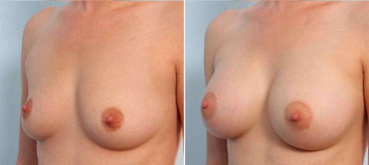 Breast Augmentation Before & After Gallery - Patient 54884008 - Image 4