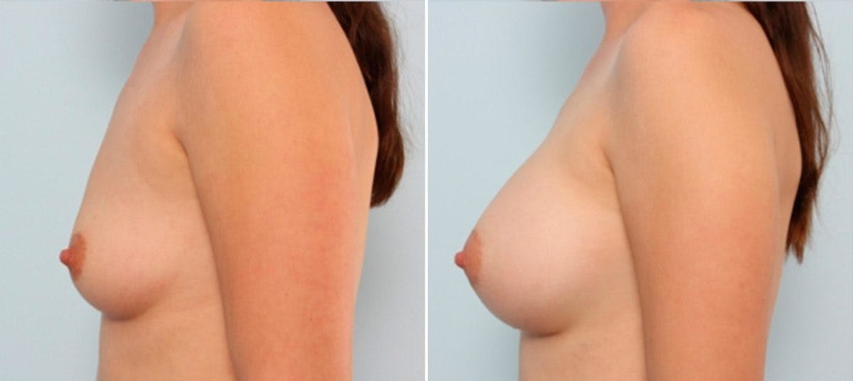 Breast Augmentation Before & After Gallery - Patient 54884008 - Image 5