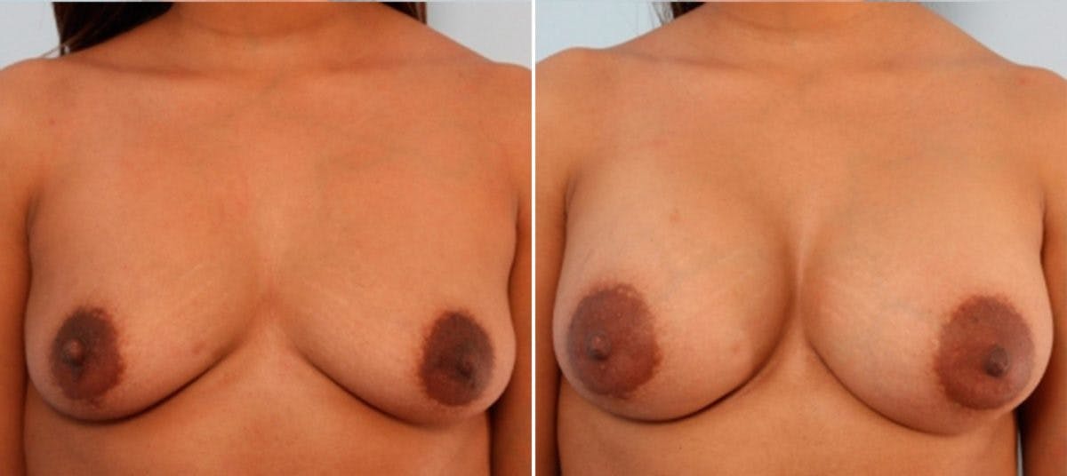 Breast Augmentation Before & After Gallery - Patient 54884010 - Image 1