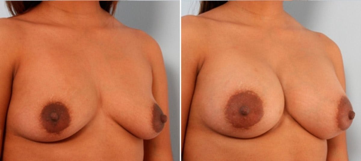 Breast Augmentation Before & After Gallery - Patient 54884010 - Image 2