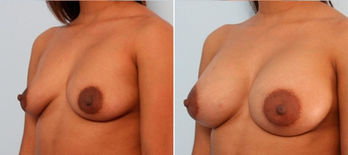 Breast Augmentation Before & After Gallery - Patient 54884010 - Image 4