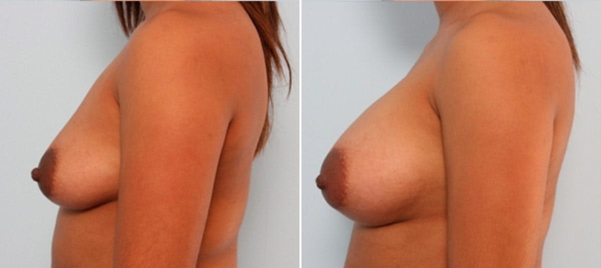 Breast Augmentation Before & After Gallery - Patient 54884010 - Image 5