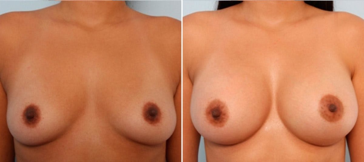 Breast Augmentation Before & After Gallery - Patient 54884011 - Image 1