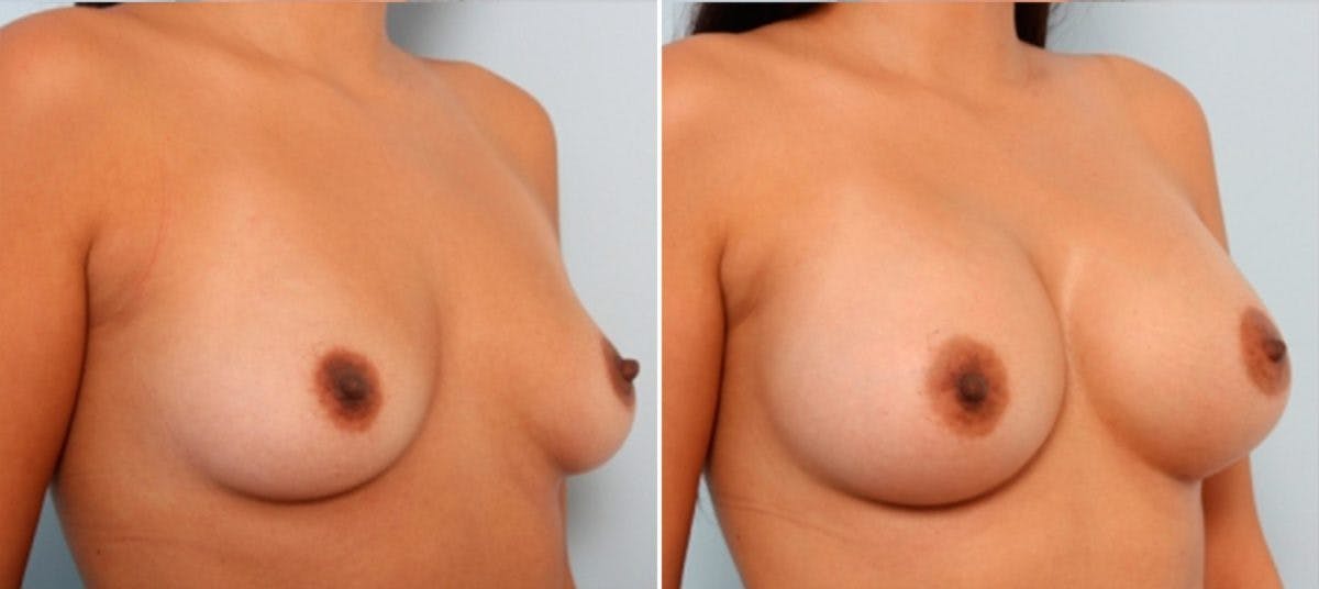 Breast Augmentation Before & After Gallery - Patient 54884011 - Image 2