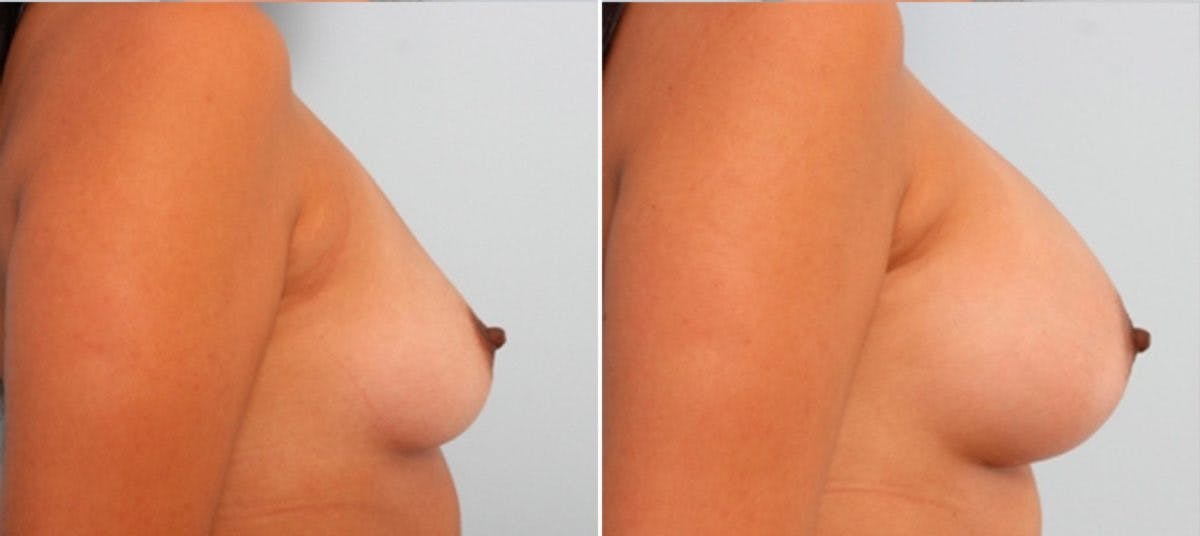Breast Augmentation Before & After Gallery - Patient 54884011 - Image 3