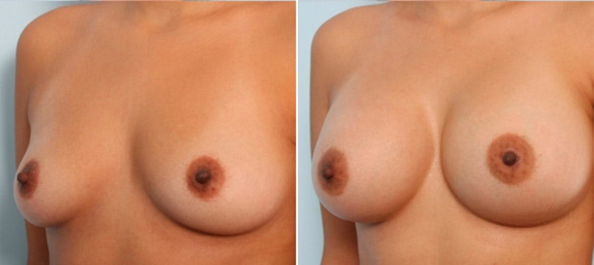 Breast Augmentation Before & After Gallery - Patient 54884011 - Image 4