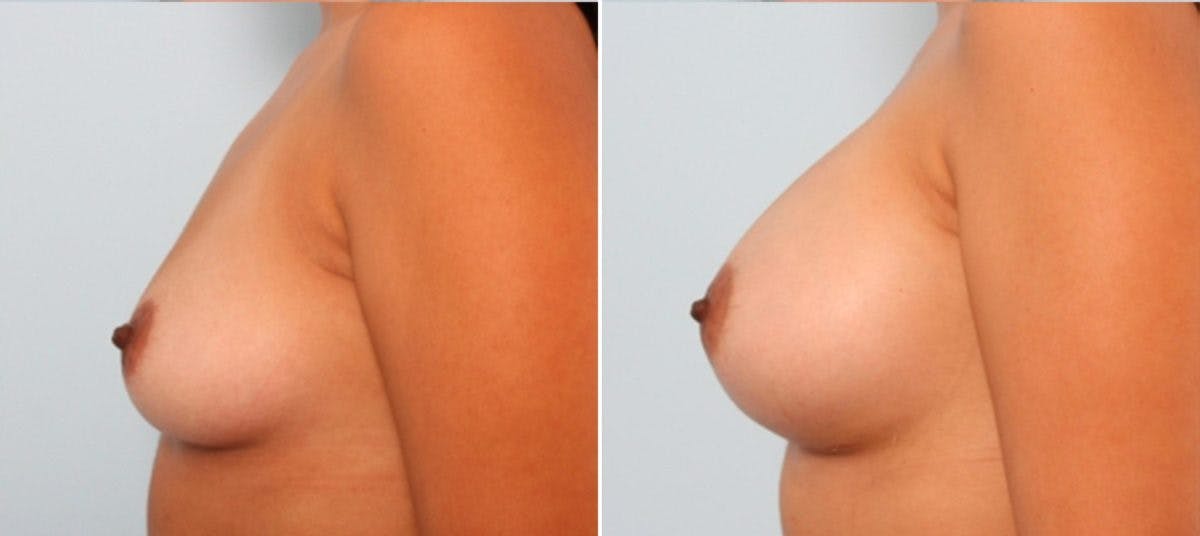 Breast Augmentation Before & After Gallery - Patient 54884011 - Image 5