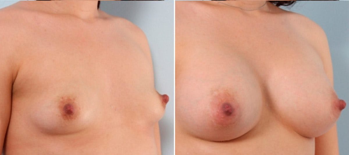 Breast Augmentation Before & After Gallery - Patient 54884012 - Image 2