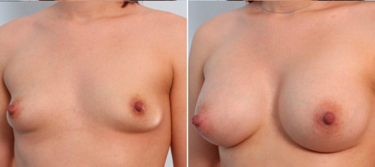 Breast Augmentation Before & After Gallery - Patient 54884012 - Image 4
