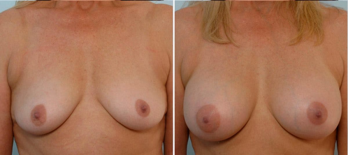 Breast Augmentation Before & After Gallery - Patient 54884013 - Image 1
