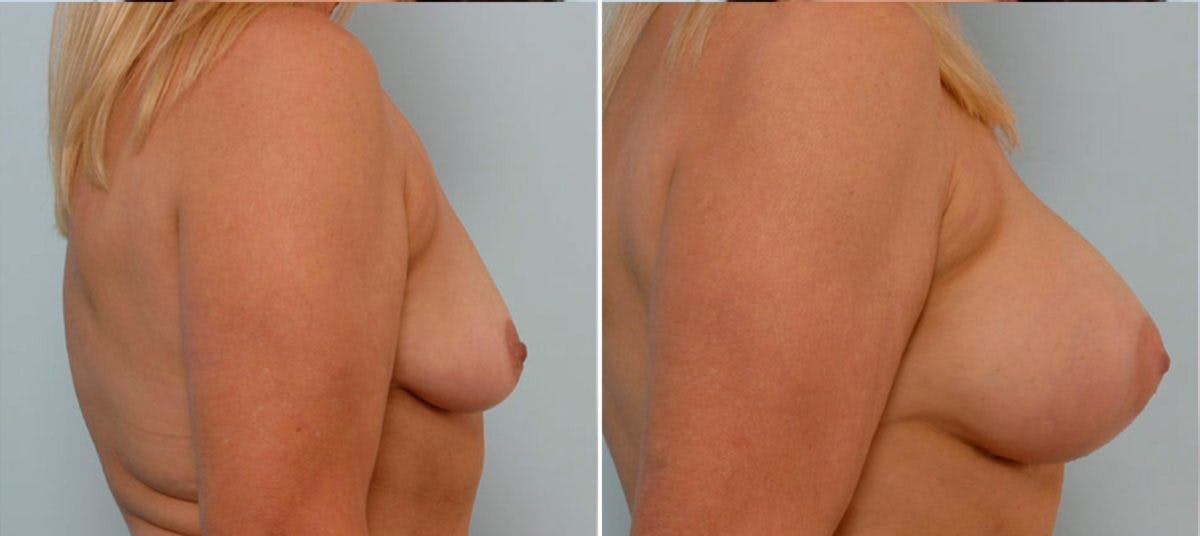Breast Augmentation Before & After Gallery - Patient 54884013 - Image 3