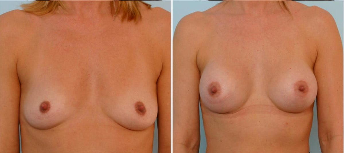 Breast Augmentation Before & After Gallery - Patient 54884014 - Image 1