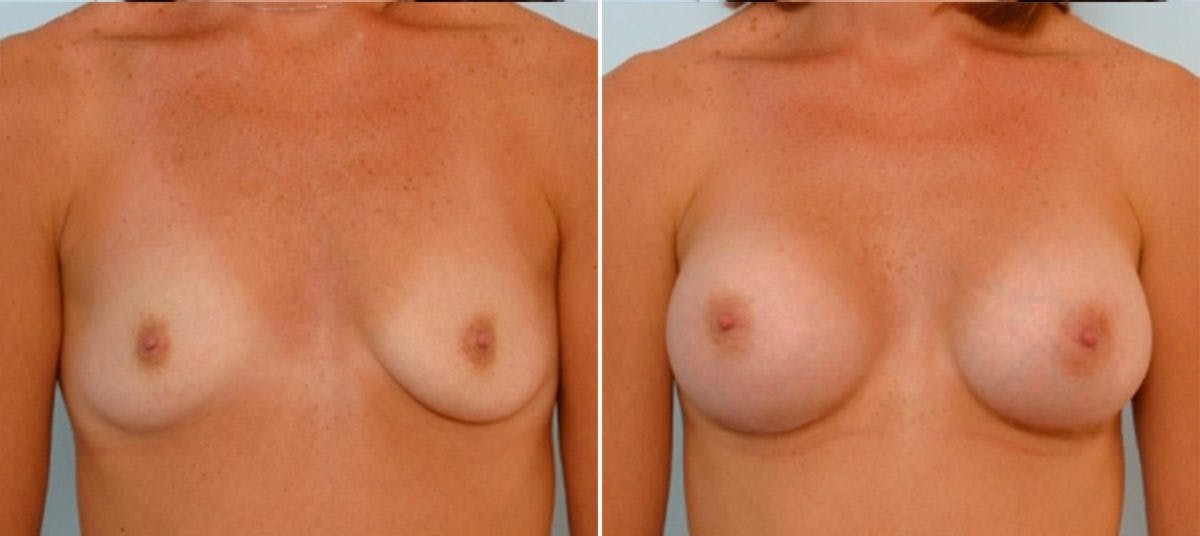 Breast Augmentation Before & After Gallery - Patient 54884020 - Image 1