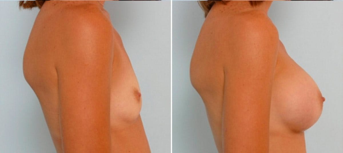 Breast Augmentation Before & After Gallery - Patient 54884020 - Image 3