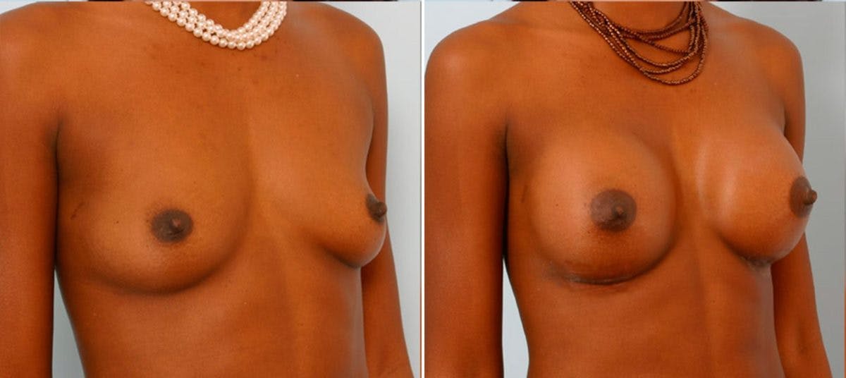 Breast Augmentation Before & After Photo - Patient 54884021 - Image 2