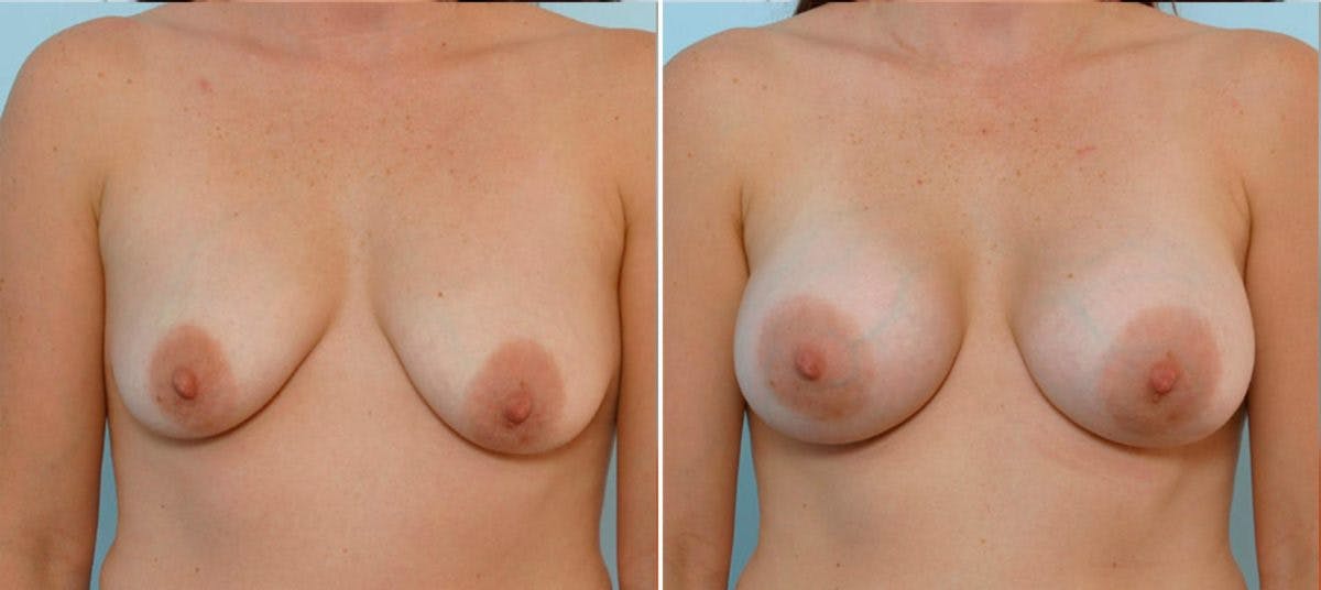 Breast Augmentation Before & After Gallery - Patient 54884022 - Image 1