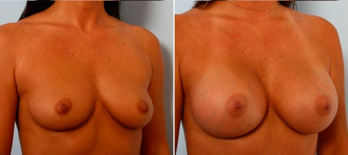 Breast Augmentation Before & After Photo - Patient 54884024 - Image 2