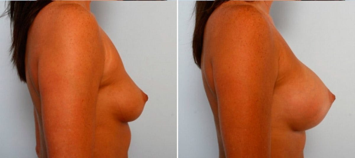 Breast Augmentation Before & After Gallery - Patient 54884024 - Image 3