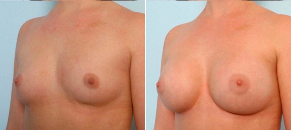 Breast Augmentation Before & After Gallery - Patient 54884026 - Image 4
