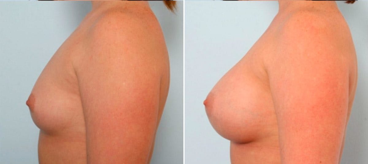 Breast Augmentation Before & After Gallery - Patient 54884026 - Image 5