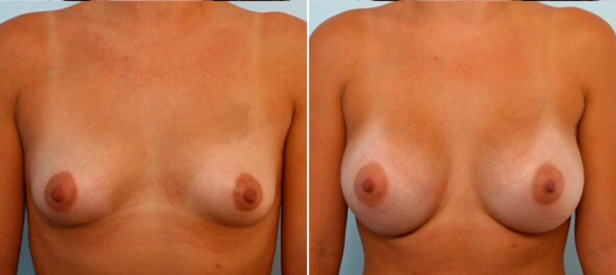 Breast Augmentation Before & After Photo - Patient 54884027 - Image 1