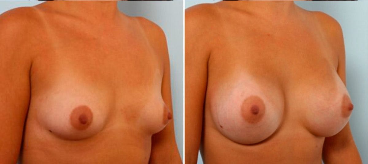 Breast Augmentation Before & After Photo - Patient 54884027 - Image 2