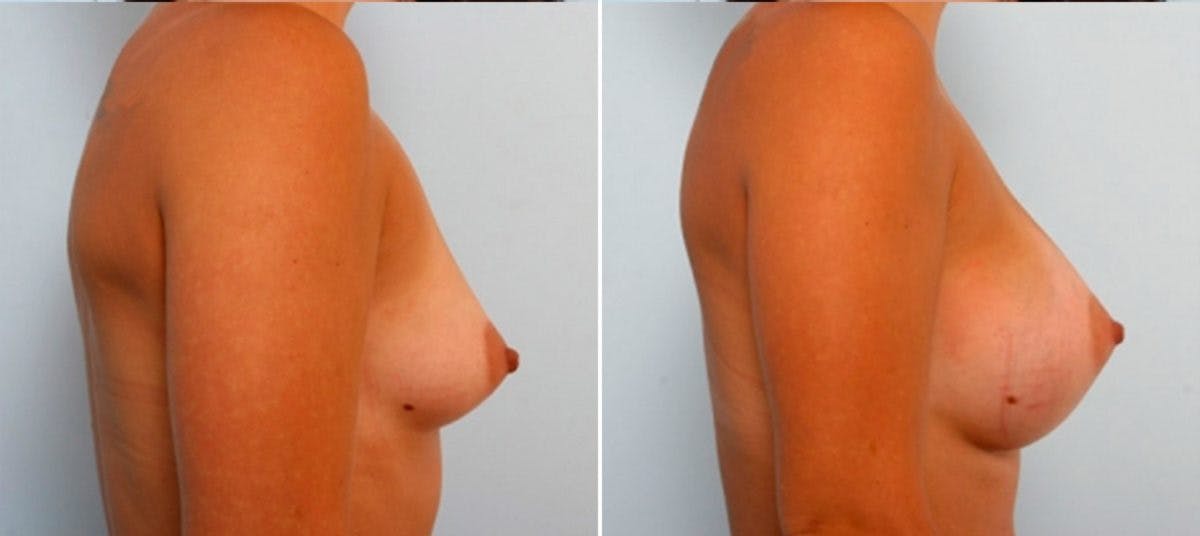 Breast Augmentation Before & After Photo - Patient 54884027 - Image 3