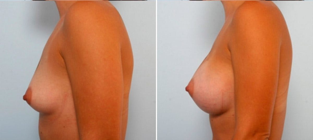 Breast Augmentation Before & After Photo - Patient 54884027 - Image 5