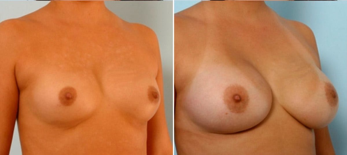 Breast Augmentation Before & After Photo - Patient 54884029 - Image 2
