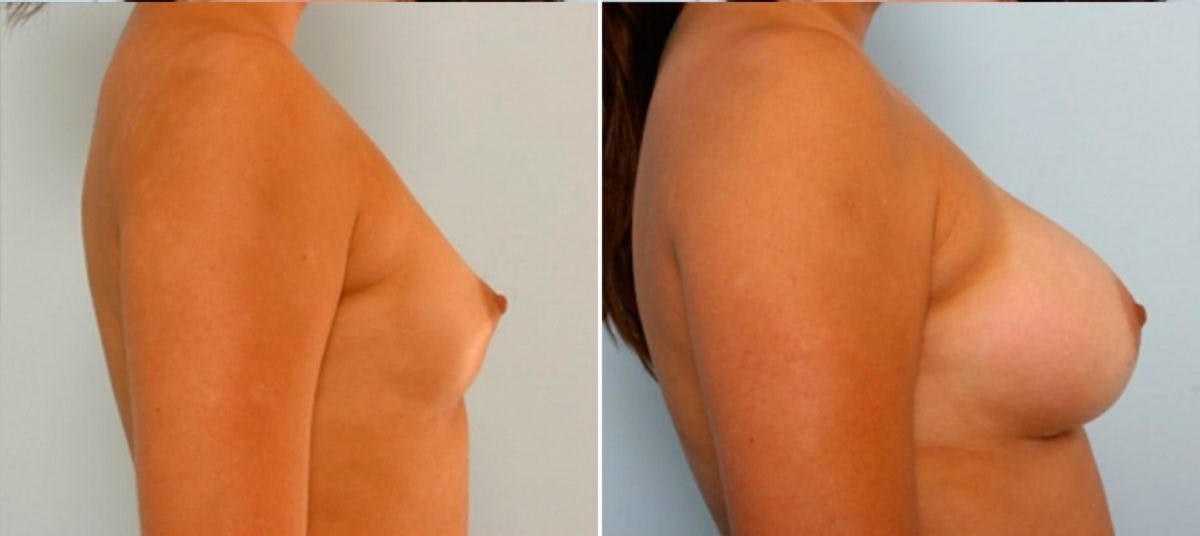 Breast Augmentation Before & After Gallery - Patient 54884029 - Image 3