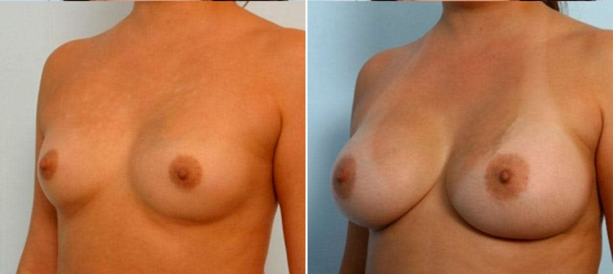 Breast Augmentation Before & After Gallery - Patient 54884029 - Image 4