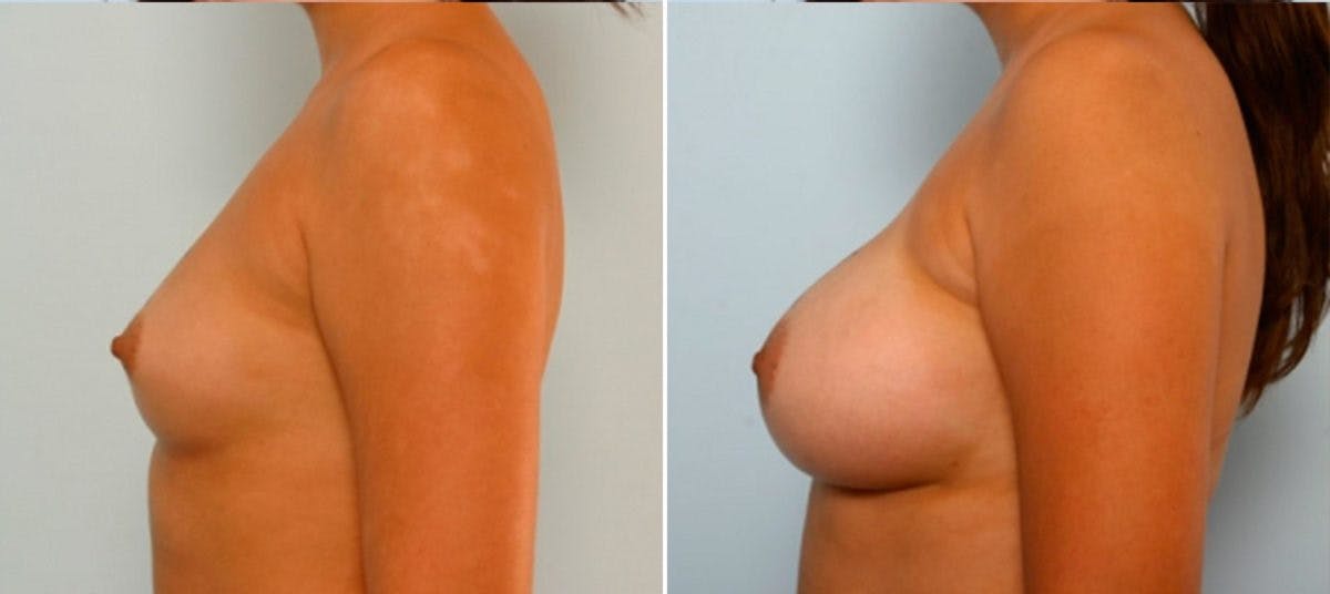 Breast Augmentation Before & After Photo - Patient 54884029 - Image 5