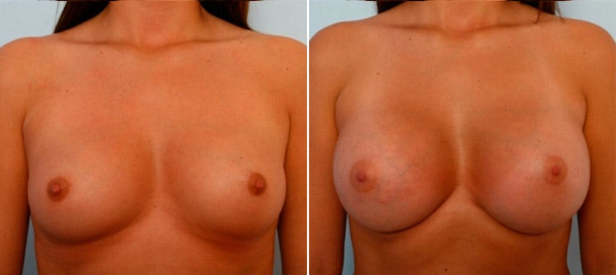 Breast Augmentation Before & After Gallery - Patient 54884030 - Image 1