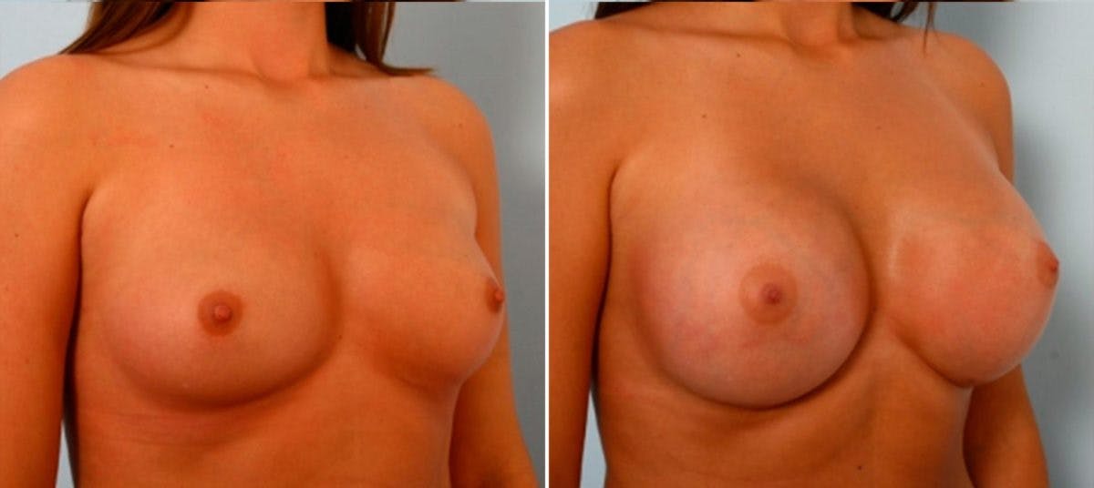 Breast Augmentation Before & After Gallery - Patient 54884030 - Image 2