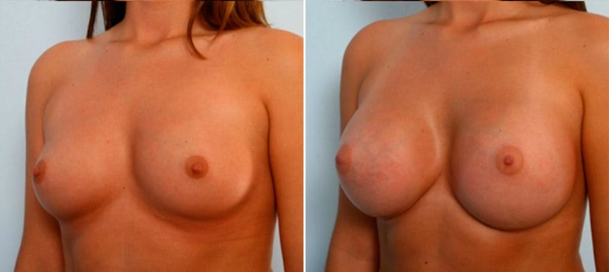 Breast Augmentation Before & After Gallery - Patient 54884030 - Image 4