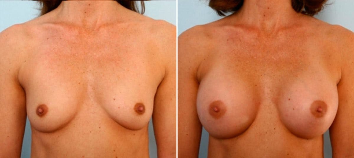 Breast Augmentation Before & After Gallery - Patient 54884033 - Image 1