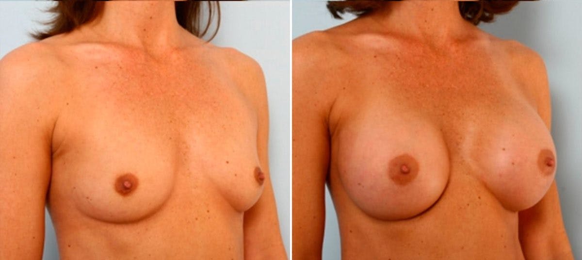 Breast Augmentation Before & After Gallery - Patient 54884033 - Image 2