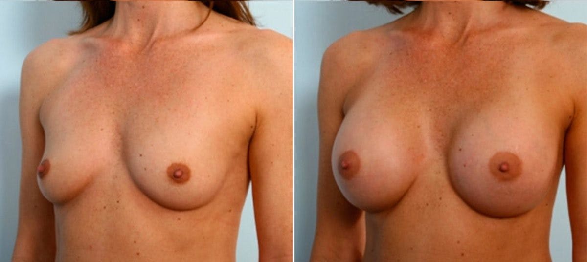 Breast Augmentation Before & After Gallery - Patient 54884033 - Image 4