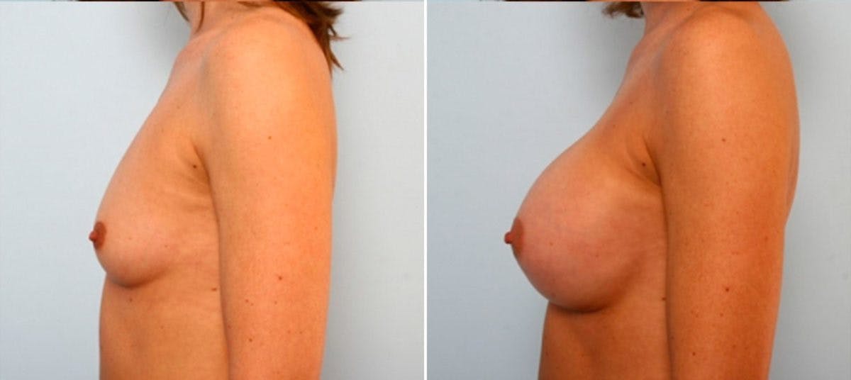 Breast Augmentation Before & After Gallery - Patient 54884033 - Image 5