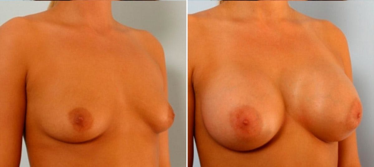 Breast Augmentation Before & After Gallery - Patient 54884034 - Image 2