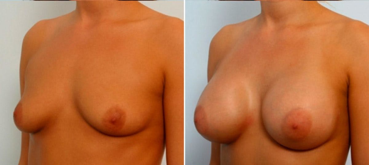 Breast Augmentation Before & After Gallery - Patient 54884034 - Image 4